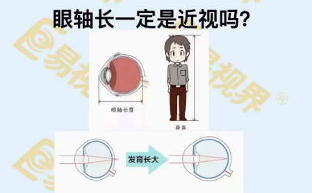 眼軸長(zhǎng)一定是近視嗎？
